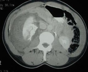 Renal laceration -right w collecting system extravasation-2